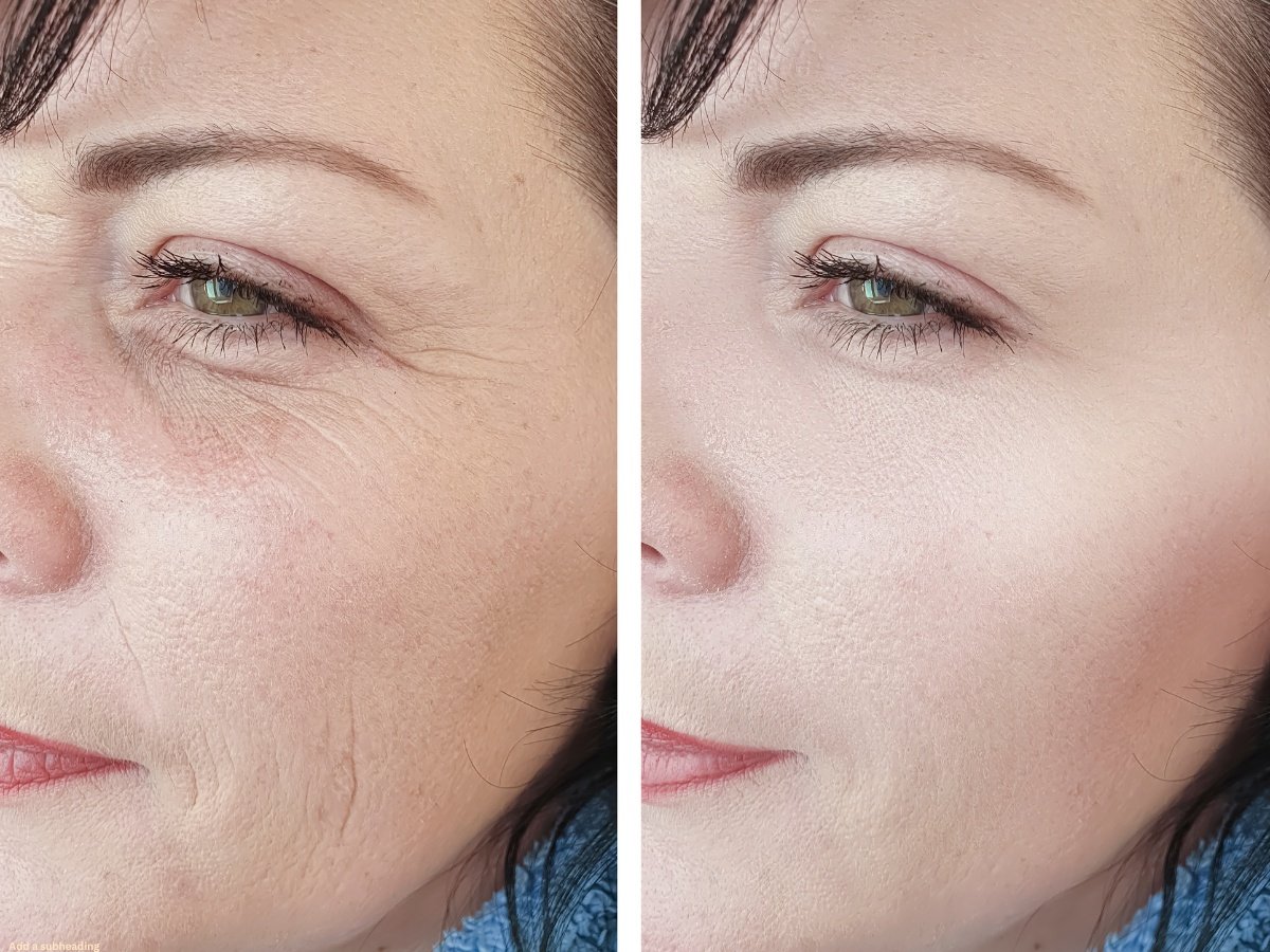 Can Fillers Look Natural