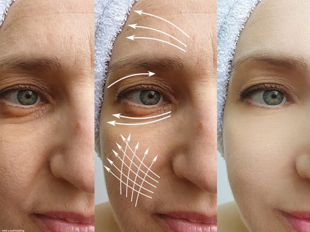 Botox for TMJ Pain