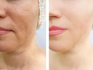 jawline treatment, Best Fillers for Smile Lines