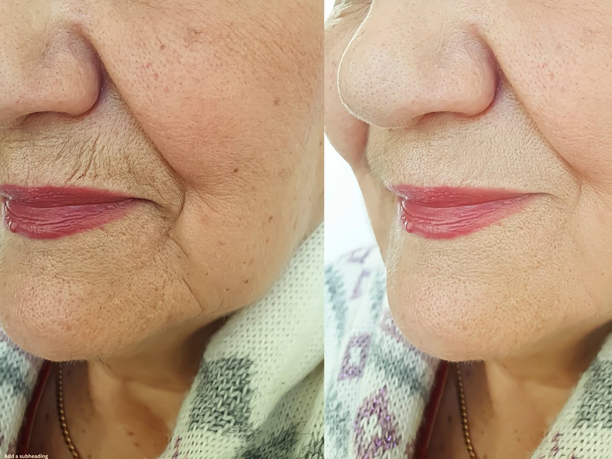 Jawline Filler Miramar FL