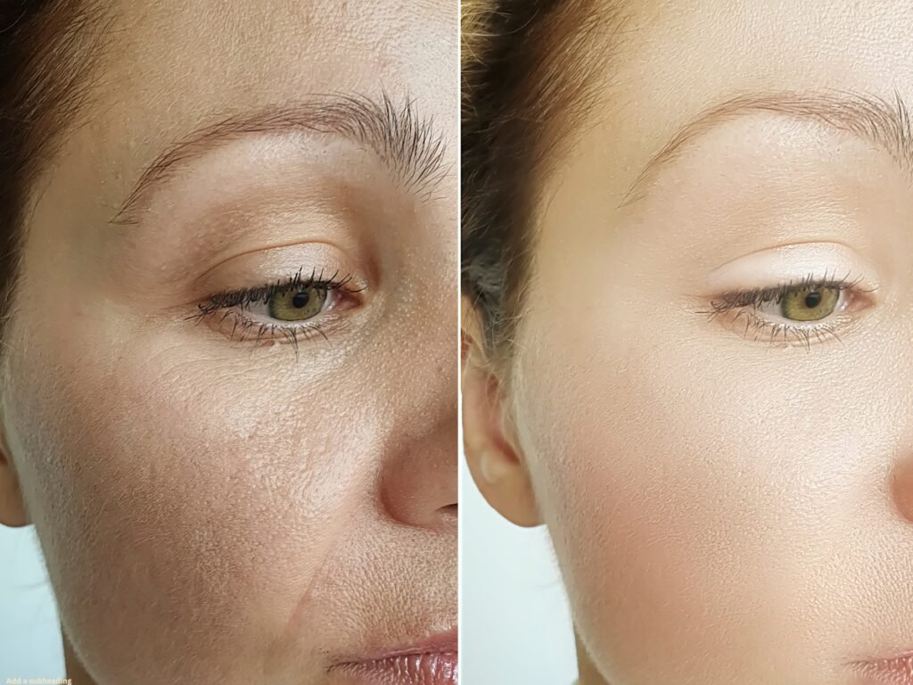 Microneedling for Acne Scars