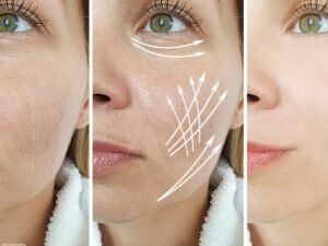 Botox for TMJ Pain