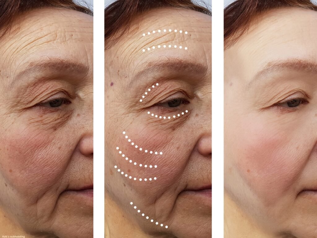 Botox for TMJ Pain