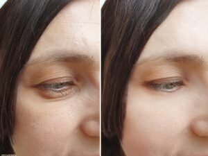 Exion vs RF Microneedling