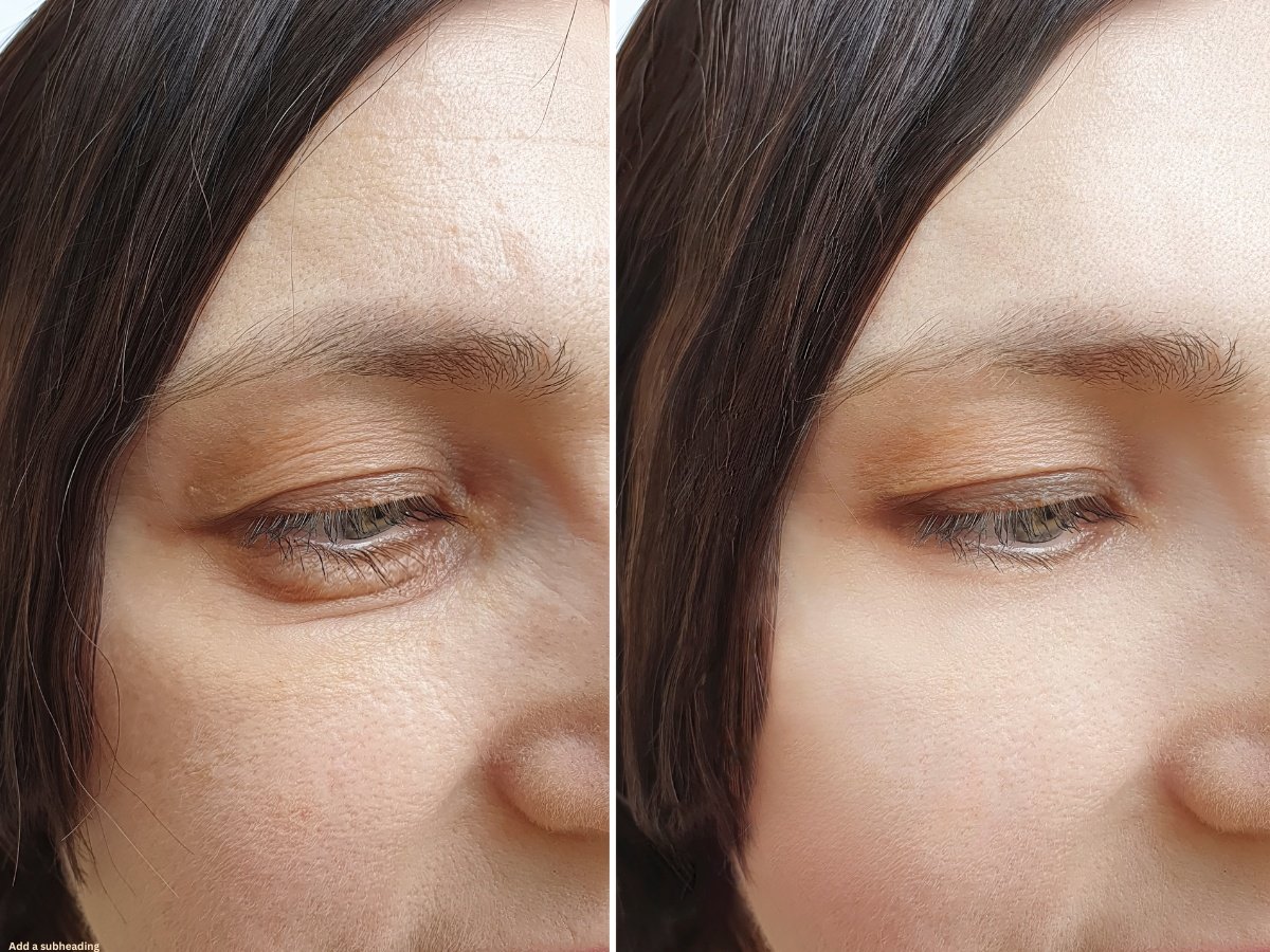 Exion vs RF Microneedling