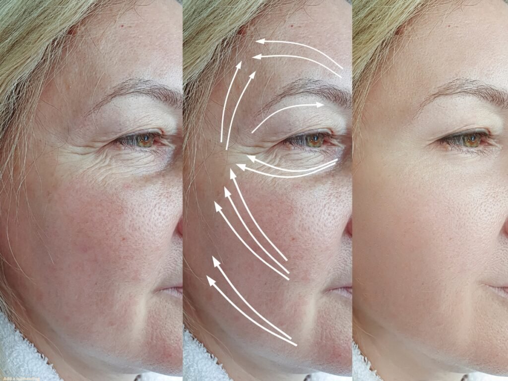 Botox for TMJ Pain