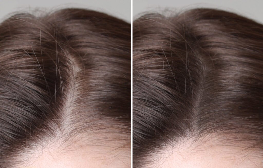 Causes of Hair Loss in Women