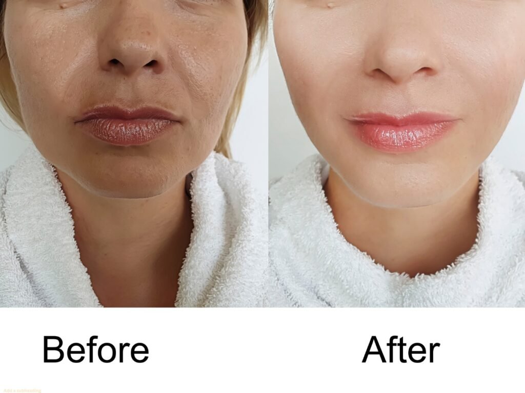 Jawline miramar, Jawline Filler Miramar FL