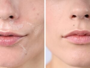 Botox Brow Lift vs Surgical Brow Lift