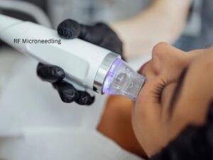 Microneedling Near Me