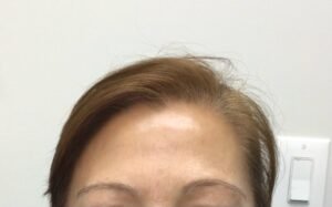 Best Treatments for Thinning Hair