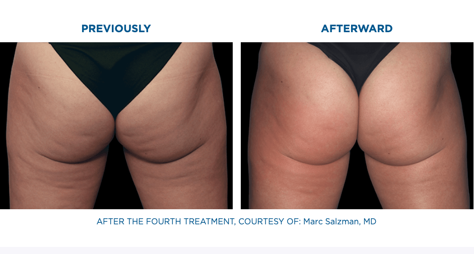 Cellulite Treatment in Miramar, FL