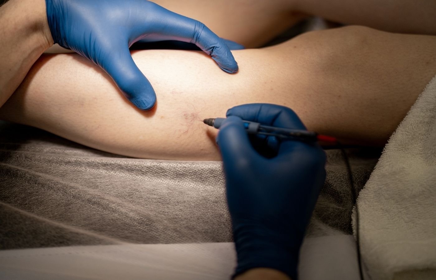 Sclerotherapy Miramar